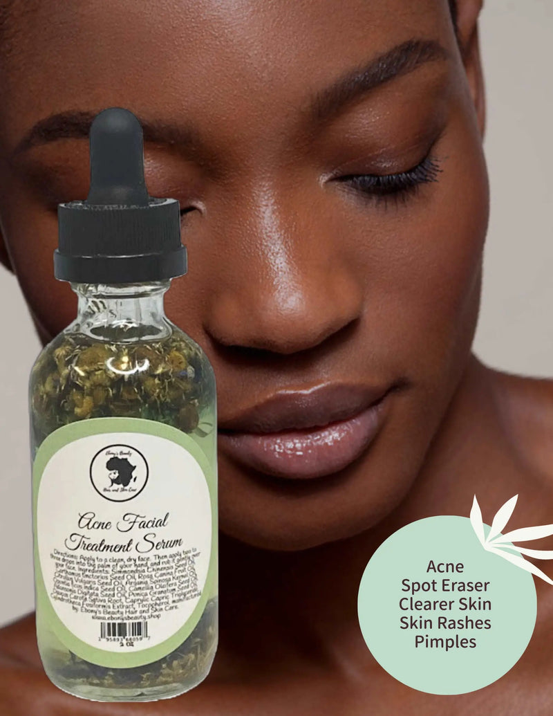 Acne Facial Serum Ebony's Beauty