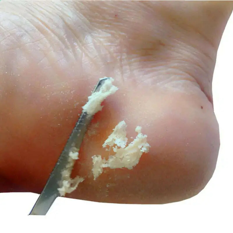 Spa-Foot-Scrubber-Pedicure-Tools-Profession-Scrape-Knife-File-for-Heels-Calluses-Blades-Bath-Exfoliating-Smooth-Feet-CareTool-GreatEagleInc-334011254
